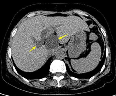 Intraductal papillary mucinous neoplasm of the biliary tract in the caudate lobe of the liver: a case report and literature review